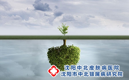 牛皮癬的危害有哪些?患了牛皮癬怎么辦?
