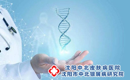 治療牛皮癬的偏方有哪些呢?沈陽皇姑區治療牛皮癬多少錢