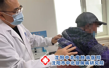 沈陽銀屑病哪看好-看銀屑病沈陽的醫(yī)院